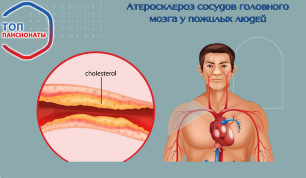 Атеросклероз сосудов головного мозга у пожилых людей